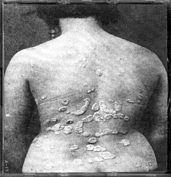 Psoriasis Gyrata Psoriasis Gyrata
